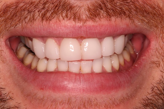 Front teeth after veneer treatment