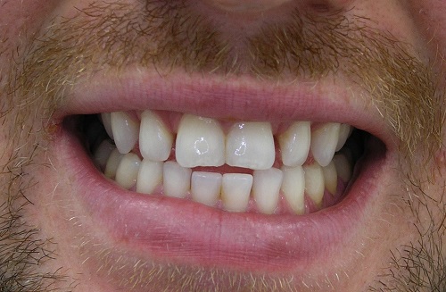 Before treatment: worn, uneven front teeth