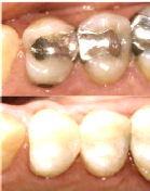 Clinical photograph: silver fillings before, and tooth-coloured fillings after treatment
